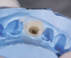 Luxatemp PLUS - пластмасса в оттиске